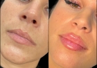 Look Refreshed with the Best Doctors in Dubai for Fillers