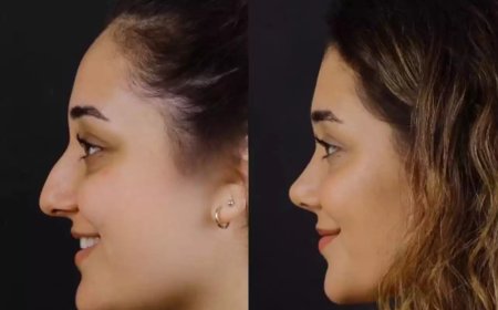 Best Doctors in Dubai Deliver Septoplasty with Precision and Care