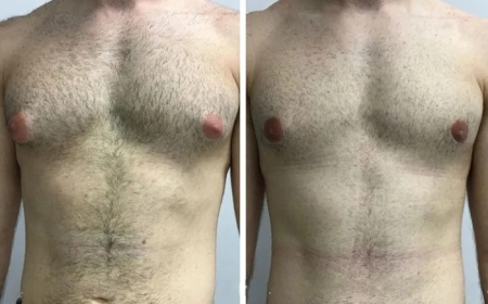 A Complete Guide to Gynecomastia Surgery in Dubai: Procedure, Cost & Recovery