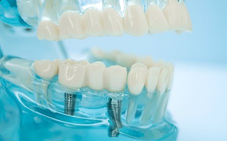 Smile with Confidence: Discover the Benefits of Dental Implants in Coral Springs