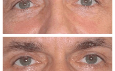 Non-Surgical vs. Surgical Eye Bag Removal Surgery in Dubai