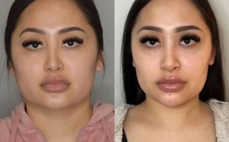 How Much Does Buccal Fat Removal Surgery in Dubai Cost?