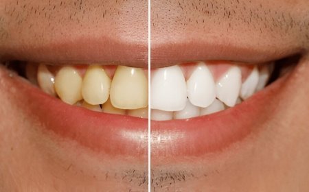 Glow Up Your Smile: Discover the Power of Teeth Whitening in Colwood
