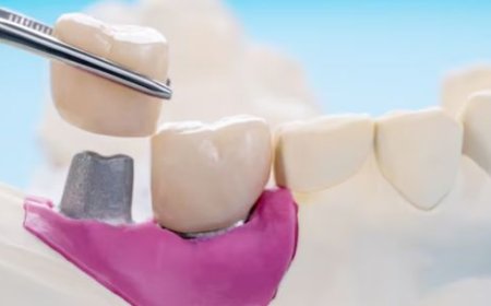 Strengthen and Restore Your Smile with Dental Crowns in NW Calgary
