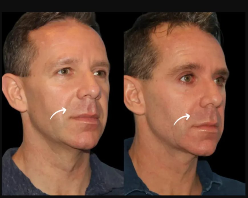 Best Doctors in Dubai Share Fall Skincare Tips with Sculptra Fillers