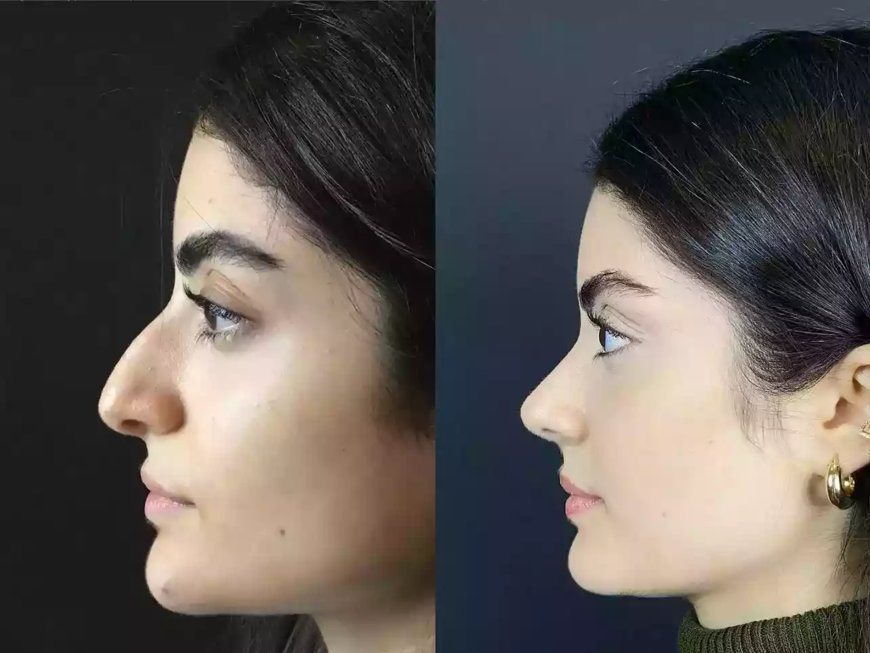 Best Doctors in Dubai Discuss How Rhinoplasty Can Improve Breathing