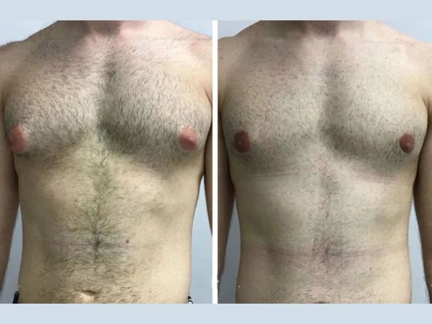 A Complete Guide to Gynecomastia Surgery in Dubai: Procedure, Cost & Recovery