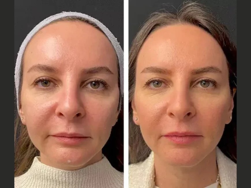 Mesotherapy Treatment in Dubai vs. Other Skin Rejuvenation Methods