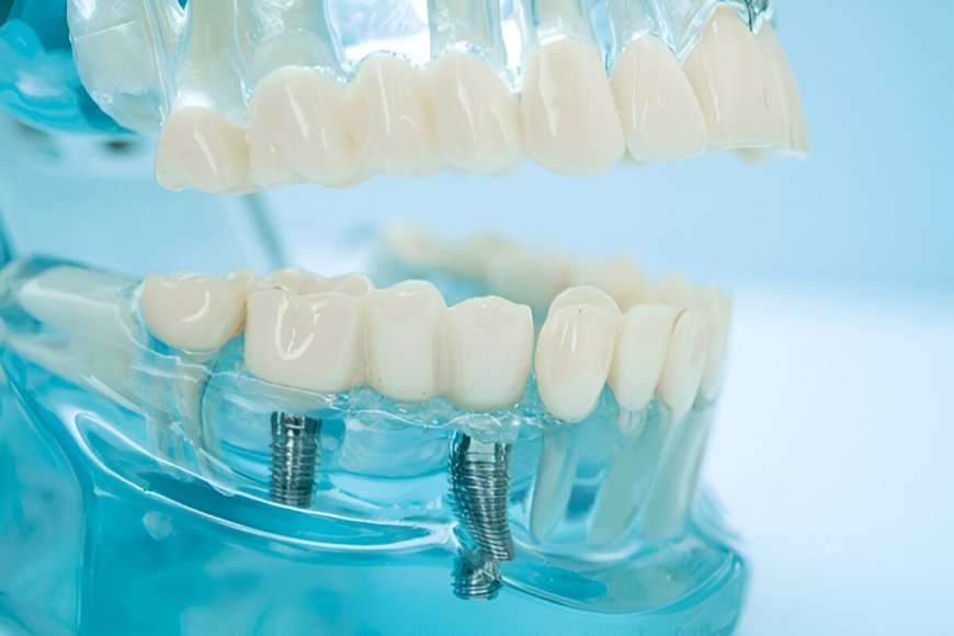 Smile with Confidence: Discover the Benefits of Dental Implants in Coral Springs