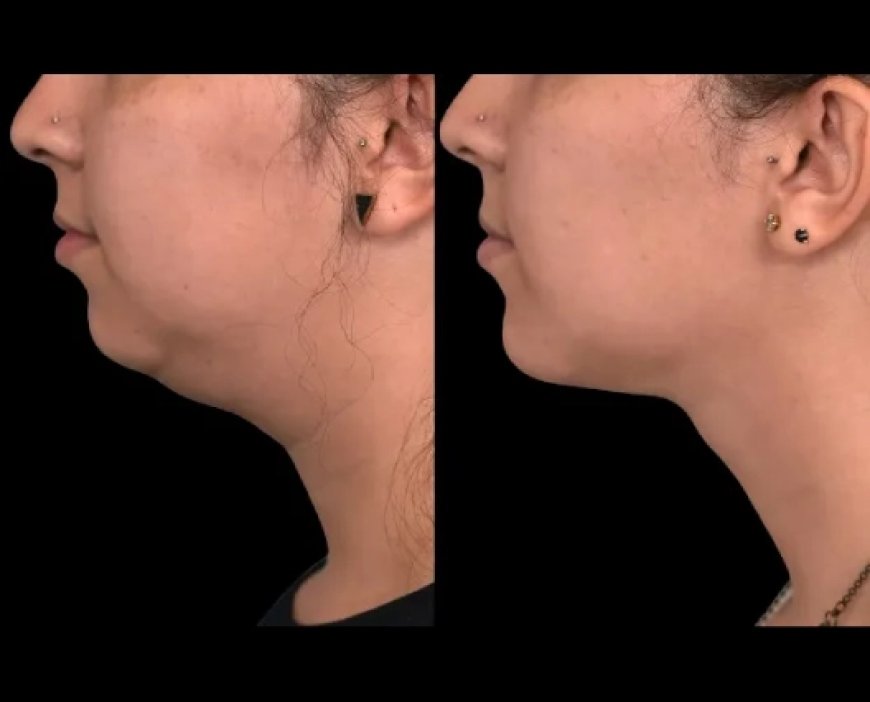 Top Benefits of Double Chin Removal Surgery in Dubai