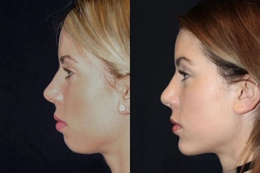 Chin Fillers Treatment in Dubai: What to Expect on Treatment Day