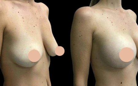 Before and After: Results from the Best Breast Augmentation Surgeons in Dubai