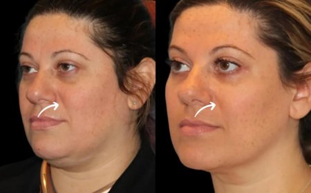 The Best Plastic Surgeon in Dubai for Correcting Sculptra Fillers Under-Corrections
