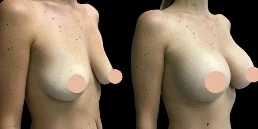 Before and After: Results from the Best Breast Augmentation Surgeons in Dubai