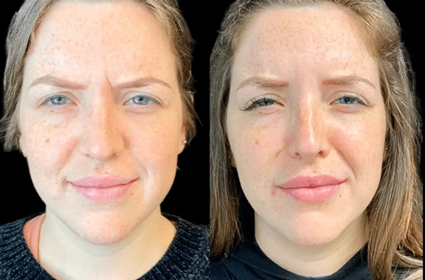 Post-Treatment Care Tips After Getting Botox in Dubai From Professionals